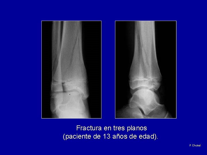  Fractura en tres planos (paciente de 13 años de edad). F Chotel 