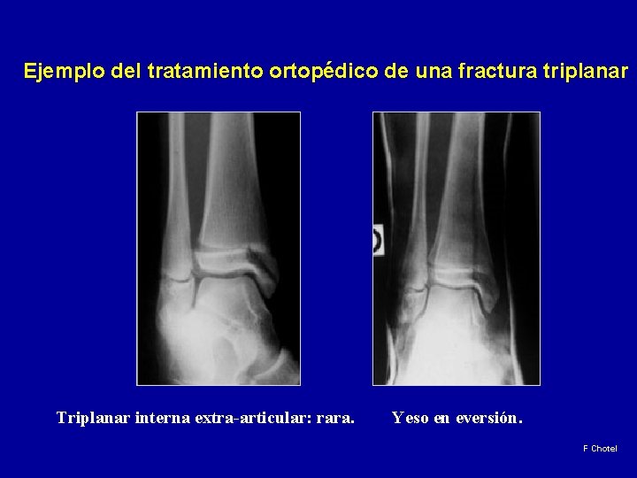 Ejemplo del tratamiento ortopédico de una fractura triplanar Triplanar interna extra-articular: rara. Yeso en