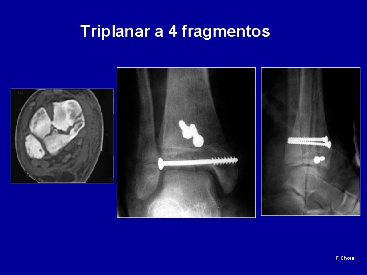 Triplanar a 4 fragmentos F Chotel 