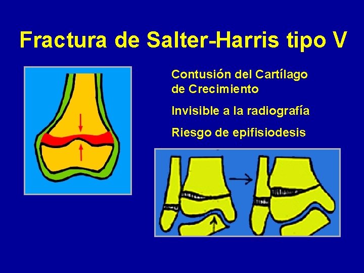 Fractura de Salter-Harris tipo V Contusión del Cartílago de Crecimiento Invisible a la radiografía