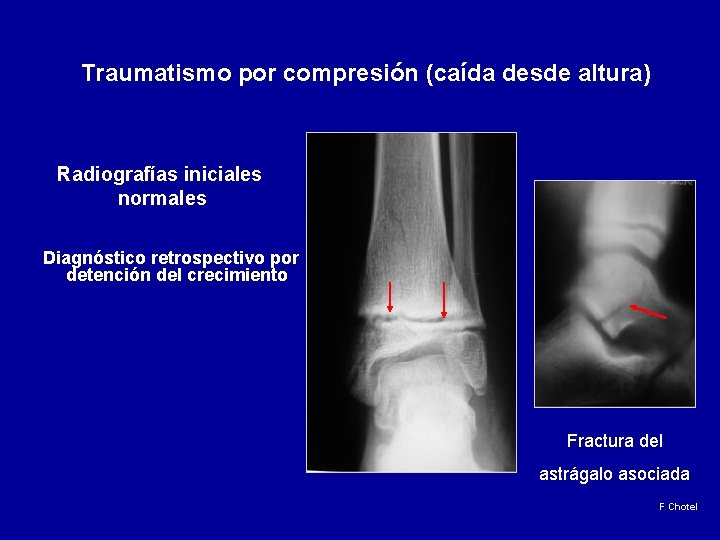Traumatismo por compresión (caída desde altura) Radiografías iniciales normales Diagnóstico retrospectivo por detención del