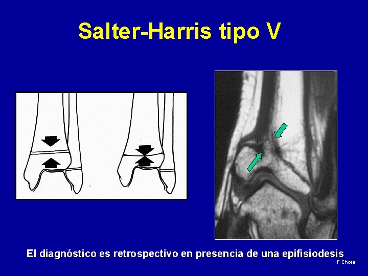 Salter-Harris tipo V El diagnóstico es retrospectivo en presencia de una epifisiodesis F Chotel