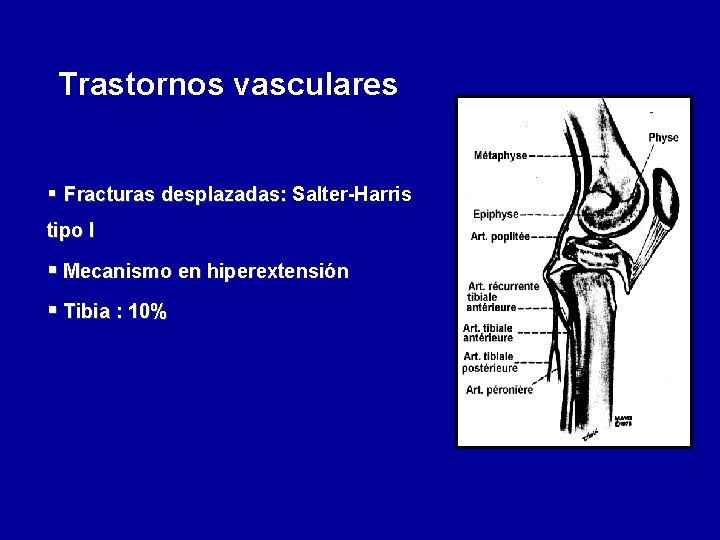 Trastornos vasculares § Fracturas desplazadas: Salter-Harris tipo I § Mecanismo en hiperextensión § Tibia