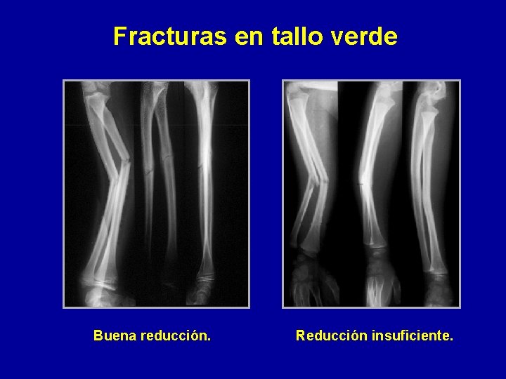 Fracturas en tallo verde Buena reducción. Reducción insuficiente. 