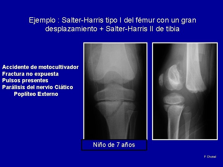 Ejemplo : Salter-Harris tipo I del fémur con un gran desplazamiento + Salter-Harris II