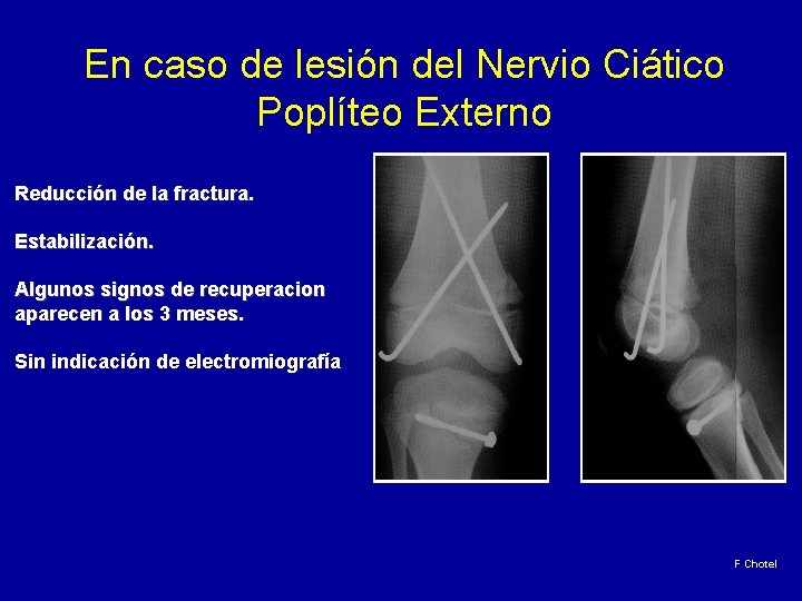 En caso de lesión del Nervio Ciático Poplíteo Externo Reducción de la fractura. Estabilización.