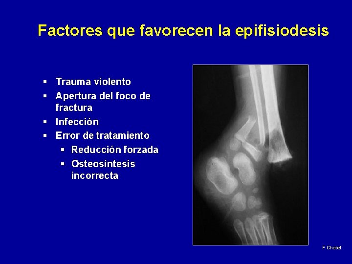 Factores que favorecen la epifisiodesis § Trauma violento § Apertura del foco de fractura