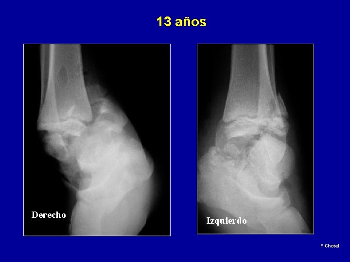 13 años Derecho Droite Izquierdo F Chotel 