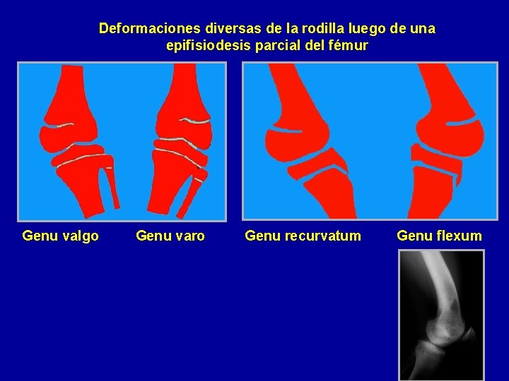 Deformaciones diversas de la rodilla luego de una epifisiodesis parcial del fémur Genu valgo