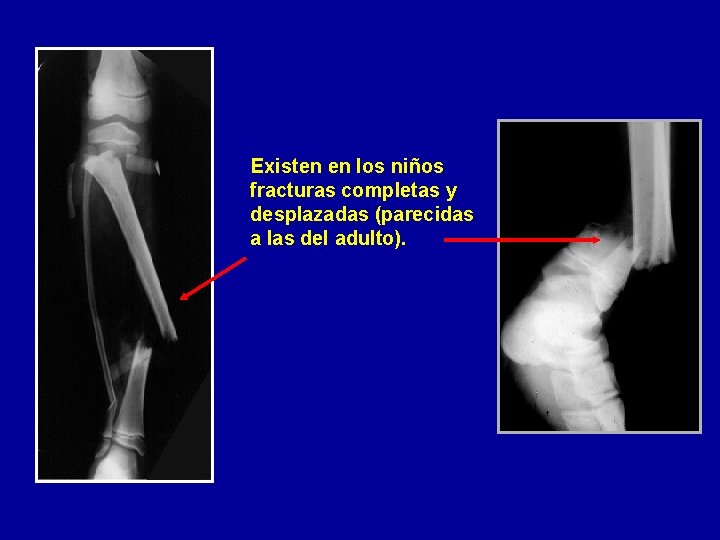 Existen en los niños fracturas completas y desplazadas (parecidas a las del adulto). 
