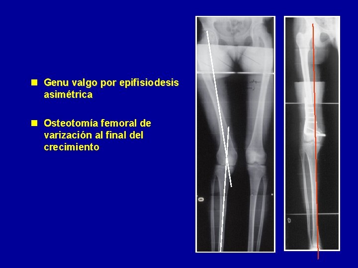 n Genu valgo por epifisiodesis asimétrica n Osteotomía femoral de varización al final del