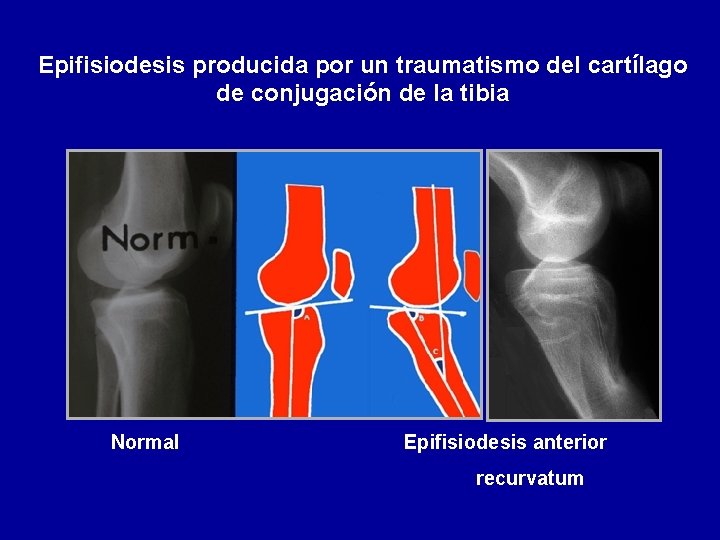 Epifisiodesis producida por un traumatismo del cartílago de conjugación de la tibia Normal Epifisiodesis