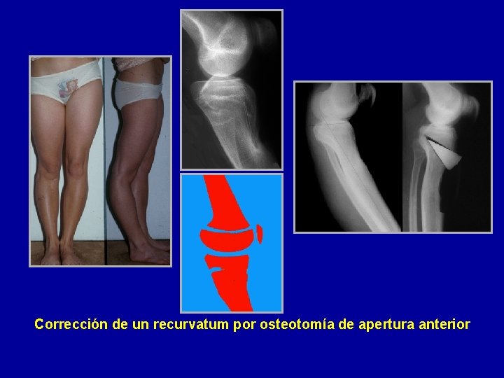 Corrección de un recurvatum por osteotomía de apertura anterior 