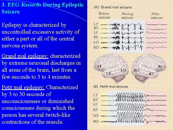 3. EEG Records During Epileptic Seizure Epilepsy is characterized by uncontrolled excessive activity of