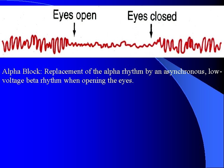 Alpha Block: Replacement of the alpha rhythm by an asynchronous, lowvoltage beta rhythm when