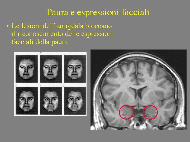 Paura e espressioni facciali • Le lesioni dell’amigdala bloccano il riconoscimento delle espressioni facciali