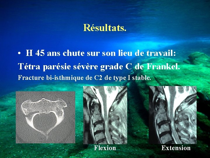 Résultats. • H 45 ans chute sur son lieu de travail: Tétra parésie sévère