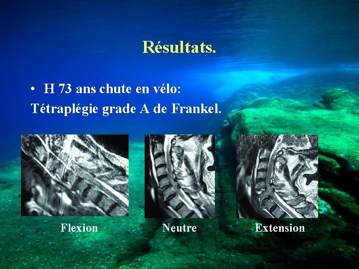 Résultats. • H 73 ans chute en vélo: Tétraplégie grade A de Frankel. Flexion