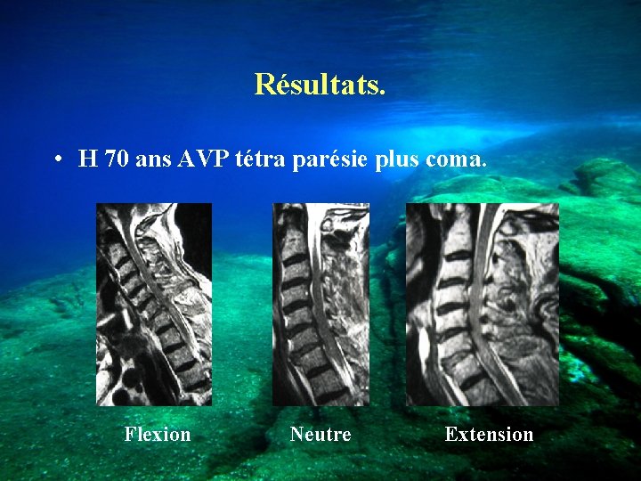Résultats. • H 70 ans AVP tétra parésie plus coma. Flexion Neutre Extension 
