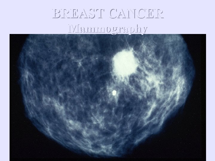 BREAST CANCER Mammography 