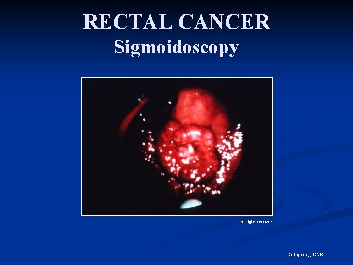 RECTAL CANCER Sigmoidoscopy All rights reserved. Dr Ligoury, CNRI. 