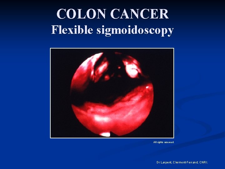 COLON CANCER Flexible sigmoidoscopy All rights reserved. Dr Larpent, Clermont-Ferrand; CNRI. 