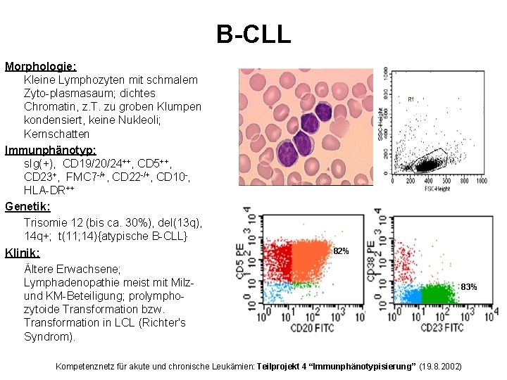 B-CLL Morphologie: Kleine Lymphozyten mit schmalem Zyto-plasmasaum; dichtes Chromatin, z. T. zu groben Klumpen