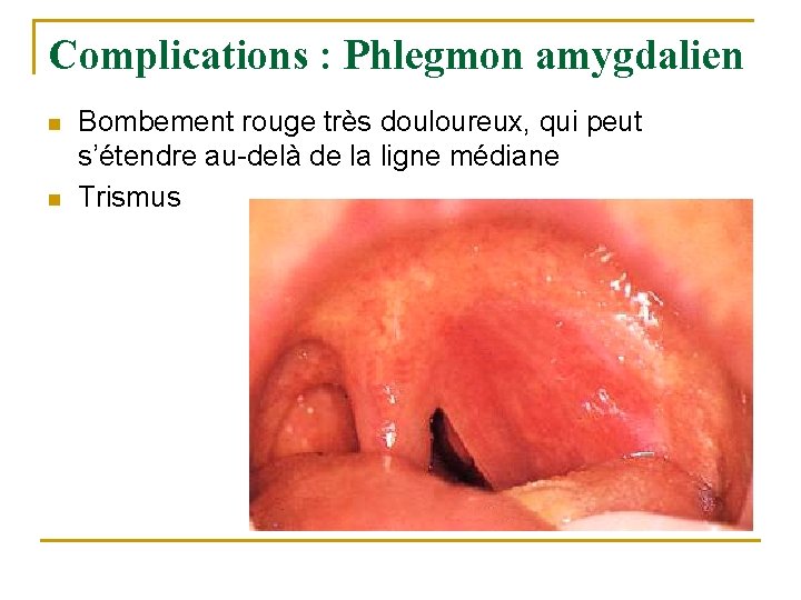 Complications : Phlegmon amygdalien n n Bombement rouge très douloureux, qui peut s’étendre au-delà Complications : Phlegmon amygdalien n n Bombement rouge très douloureux, qui peut s’étendre au-delà