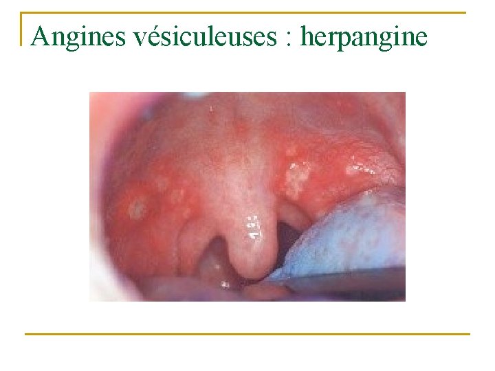 Angines vésiculeuses : herpangine Angines vésiculeuses : herpangine