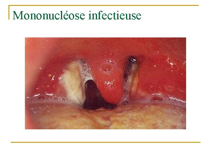 Mononucléose infectieuse Mononucléose infectieuse