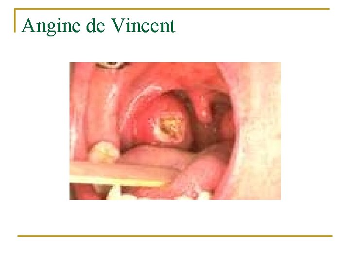 Angine de Vincent Angine de Vincent