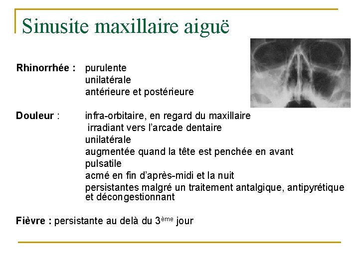 Sinusite maxillaire aiguë Rhinorrhée : Douleur : purulente unilatérale antérieure et postérieure infra-orbitaire, en Sinusite maxillaire aiguë Rhinorrhée : Douleur : purulente unilatérale antérieure et postérieure infra-orbitaire, en
