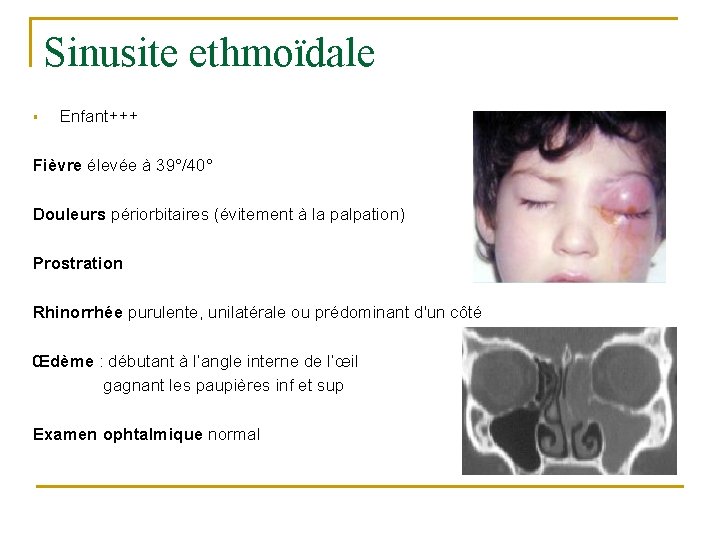 Sinusite ethmoïdale § Enfant+++ Fièvre élevée à 39°/40° Douleurs périorbitaires (évitement à la palpation) Sinusite ethmoïdale § Enfant+++ Fièvre élevée à 39°/40° Douleurs périorbitaires (évitement à la palpation)