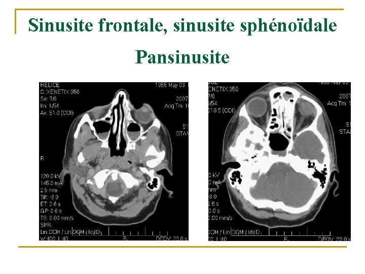Sinusite frontale, sinusite sphénoïdale Pansinusite Sinusite frontale, sinusite sphénoïdale Pansinusite