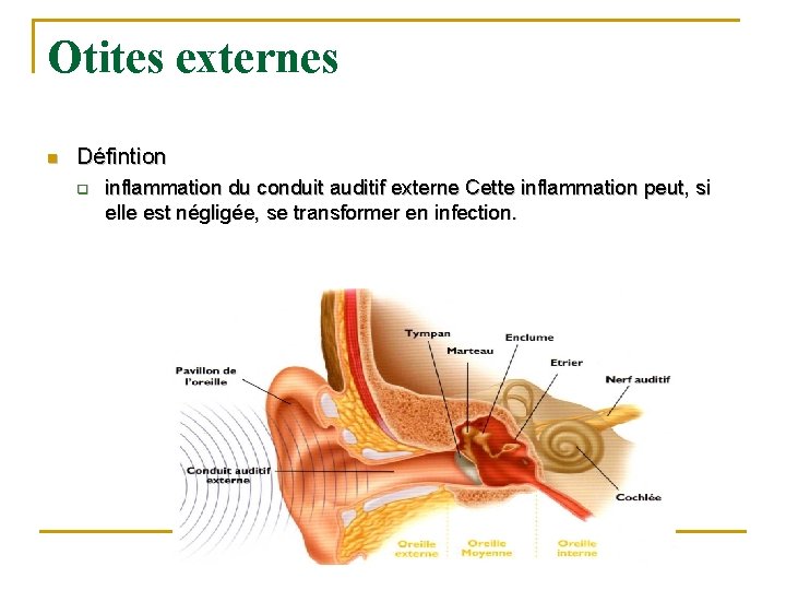 Otites externes n Défintion q inflammation du conduit auditif externe Cette inflammation peut, si Otites externes n Défintion q inflammation du conduit auditif externe Cette inflammation peut, si