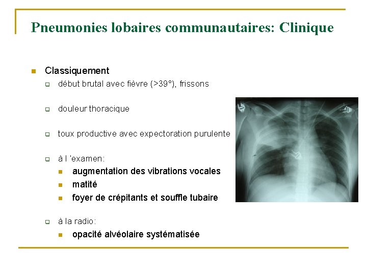 Pneumonies lobaires communautaires: Clinique n Classiquement q début brutal avec fièvre (>39°), frissons q Pneumonies lobaires communautaires: Clinique n Classiquement q début brutal avec fièvre (>39°), frissons q