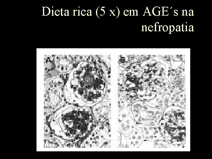 Dieta rica (5 x) em AGE´s na nefropatia 