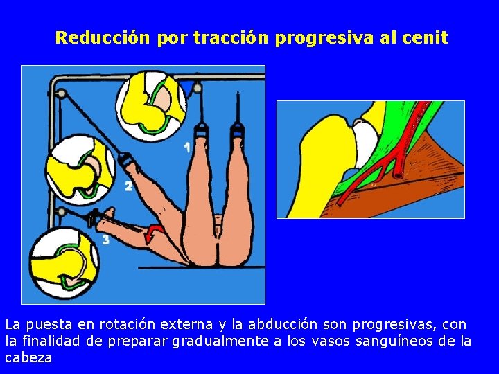 Reducción por tracción progresiva al cenit La puesta en rotación externa y la abducción