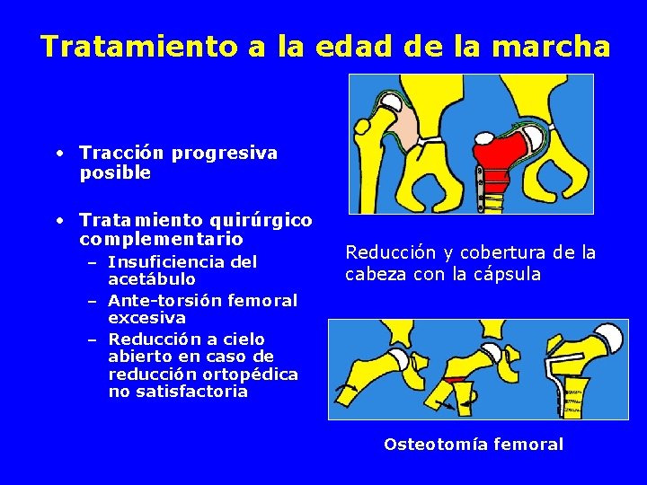 Tratamiento a la edad de la marcha • Tracción progresiva posible • Tratamiento quirúrgico