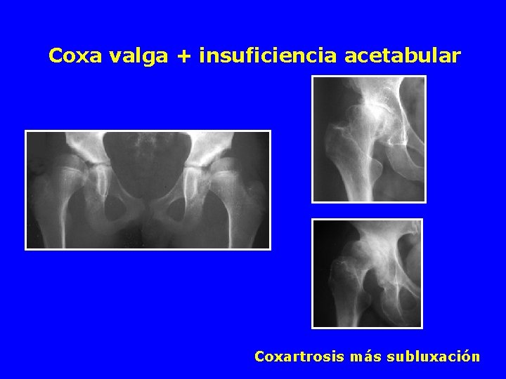 Coxa valga + insuficiencia acetabular Coxartrosis más subluxación 