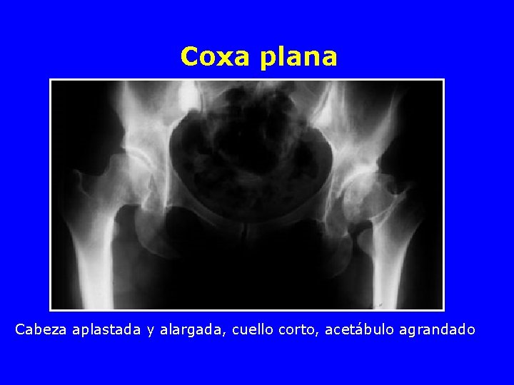 Coxa plana Cabeza aplastada y alargada, cuello corto, acetábulo agrandado 