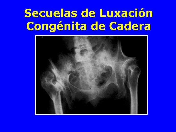 Secuelas de Luxación Congénita de Cadera 