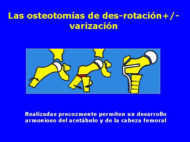Las osteotomías de des-rotación+/varización Realizadas precozmente permiten un desarrollo armonioso del acetábulo y de