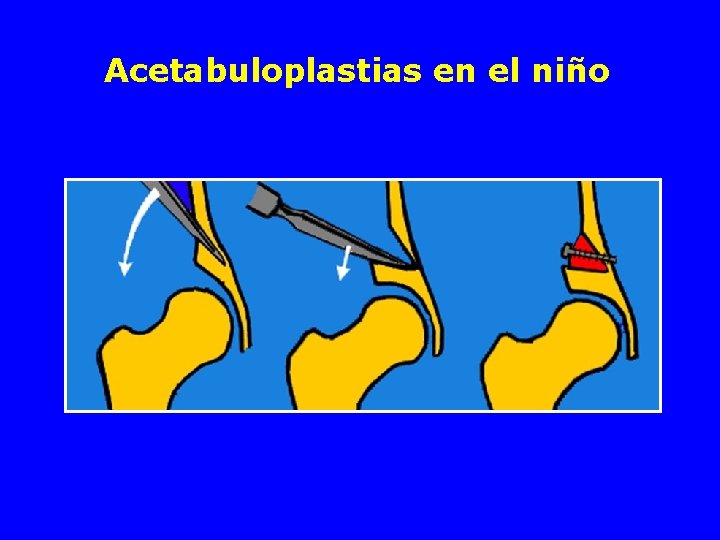 Acetabuloplastias en el niño 