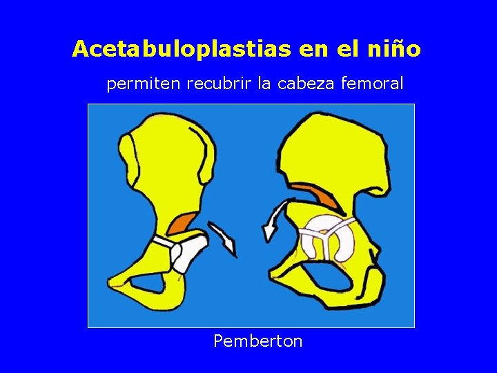Acetabuloplastias en el niño permiten recubrir la cabeza femoral Pemberton 