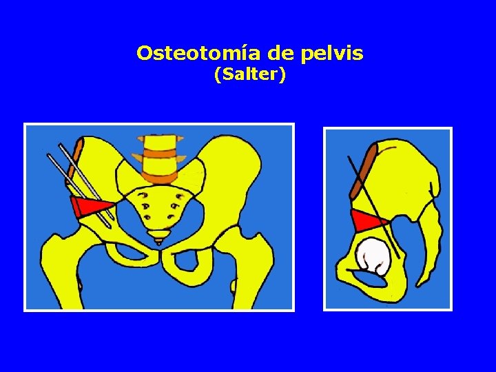 Osteotomía de pelvis (Salter) 