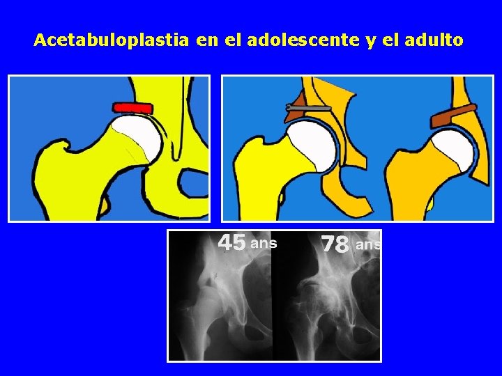 Acetabuloplastia en el adolescente y el adulto 