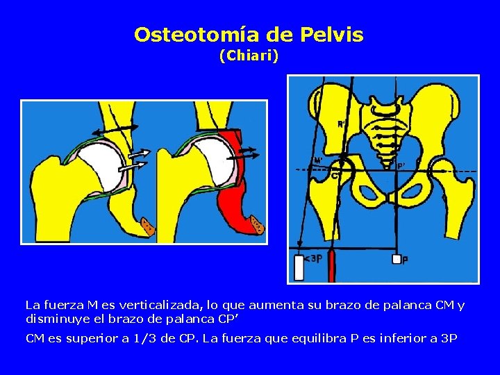 Osteotomía de Pelvis (Chiari) Translation de la tête et couverture La fuerza M es