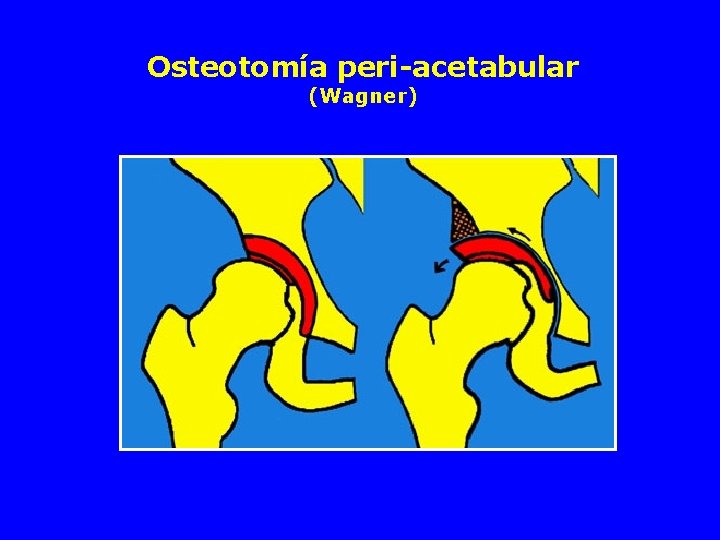 Osteotomía peri-acetabular (Wagner) 