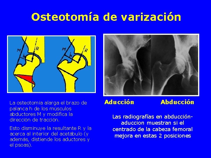 Osteotomía de varización La osteotomía alarga el brazo de palanca h de los músculos